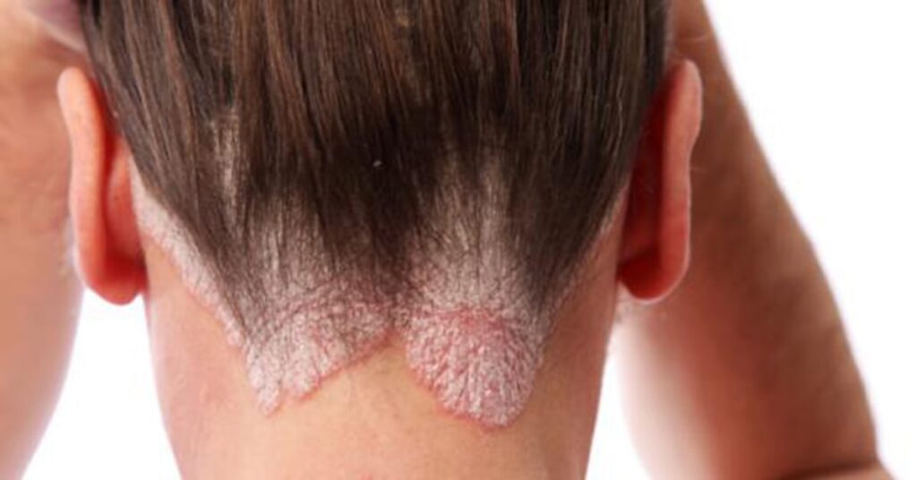 Dealing with eczema naturally
