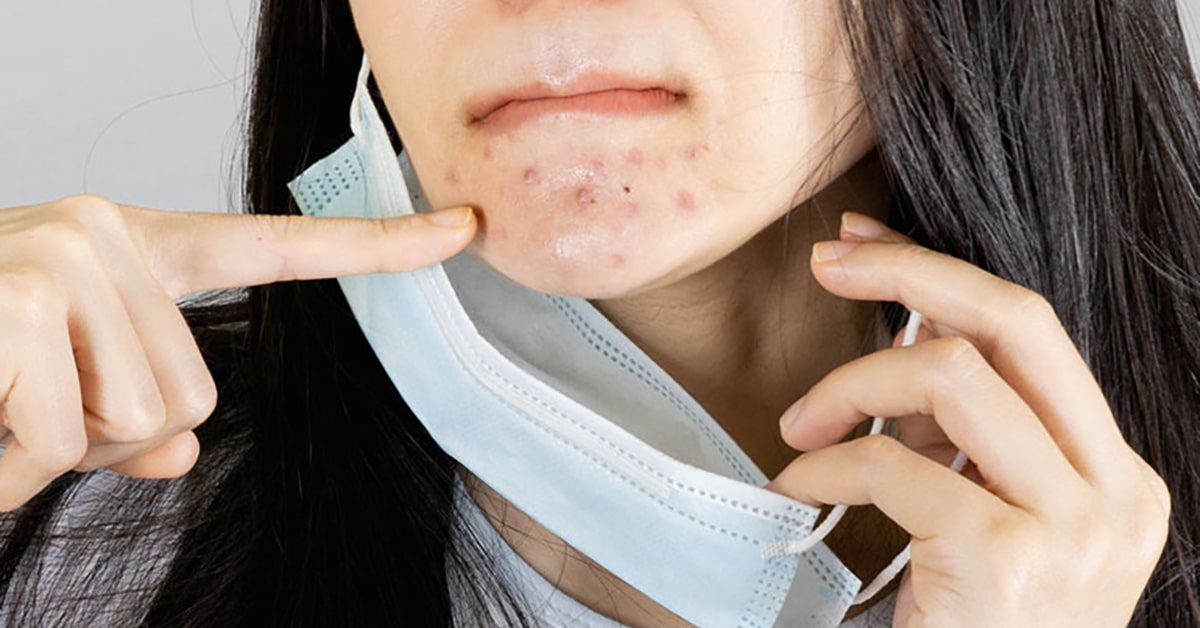 maskne