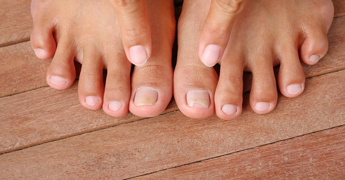 What kills nail fungus