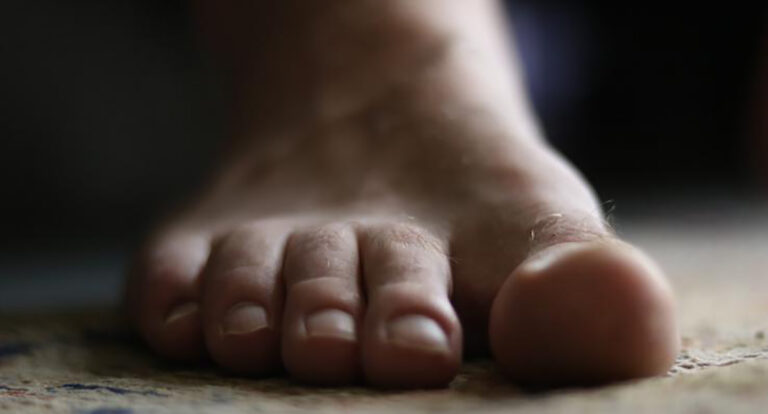 Toe nail fungus
